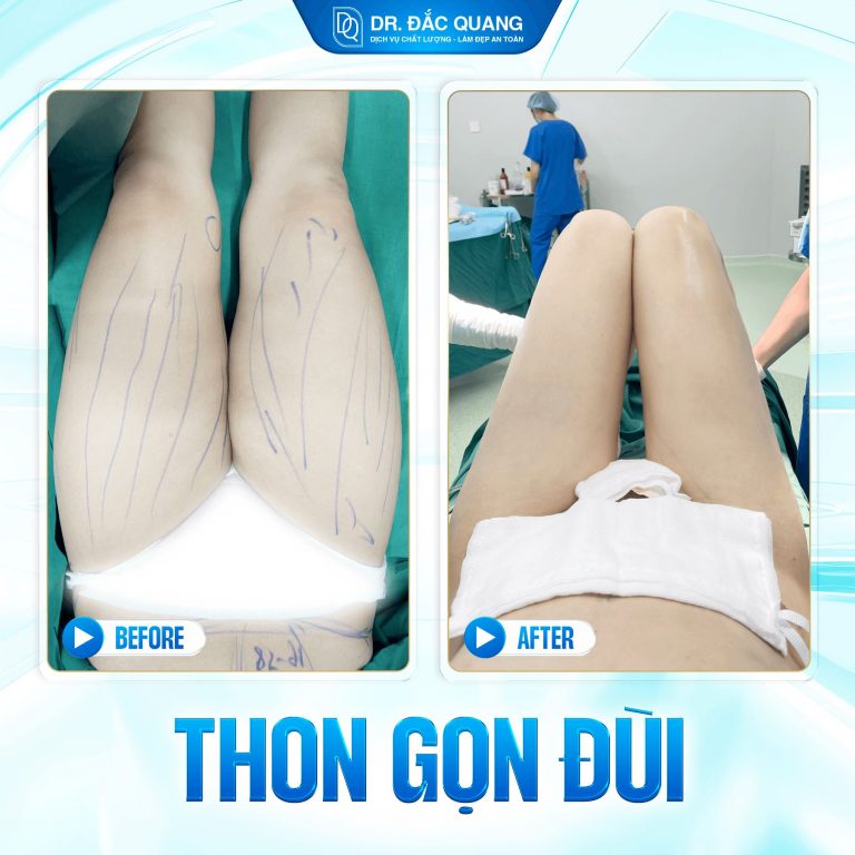hút mỡ đùi, hút mỡ bắp chân
