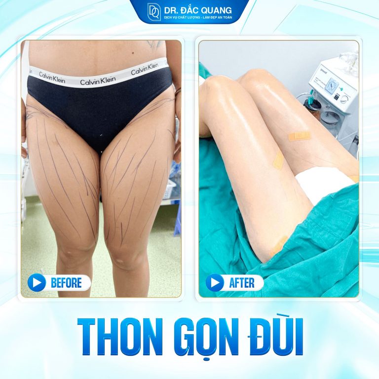 hút mỡ đùi, hút mỡ bắp chân