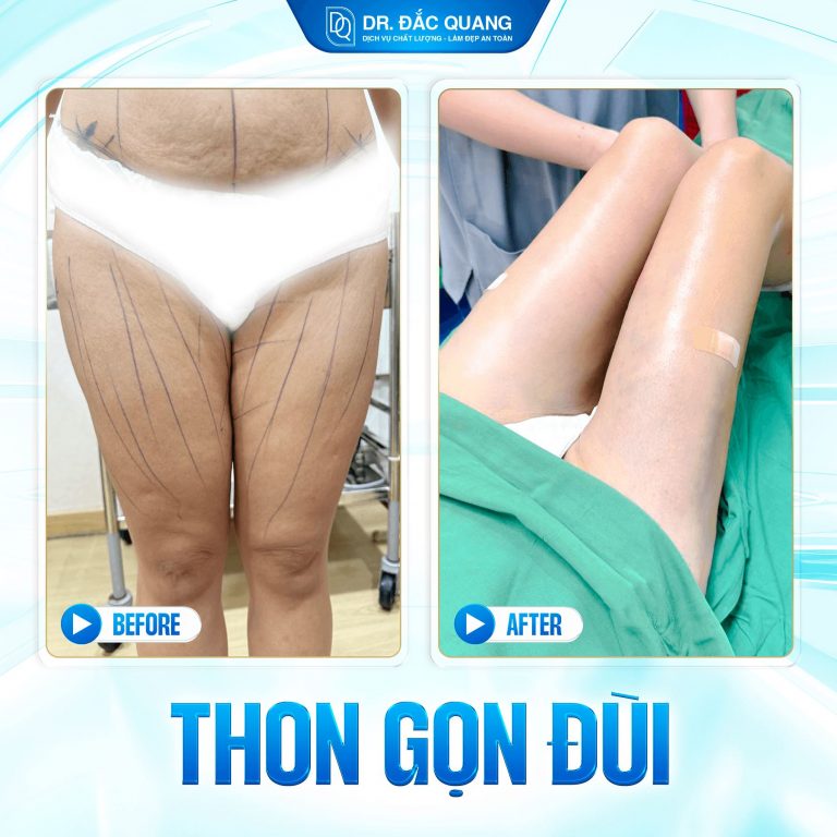 hút mỡ đùi, hút mỡ bắp chân