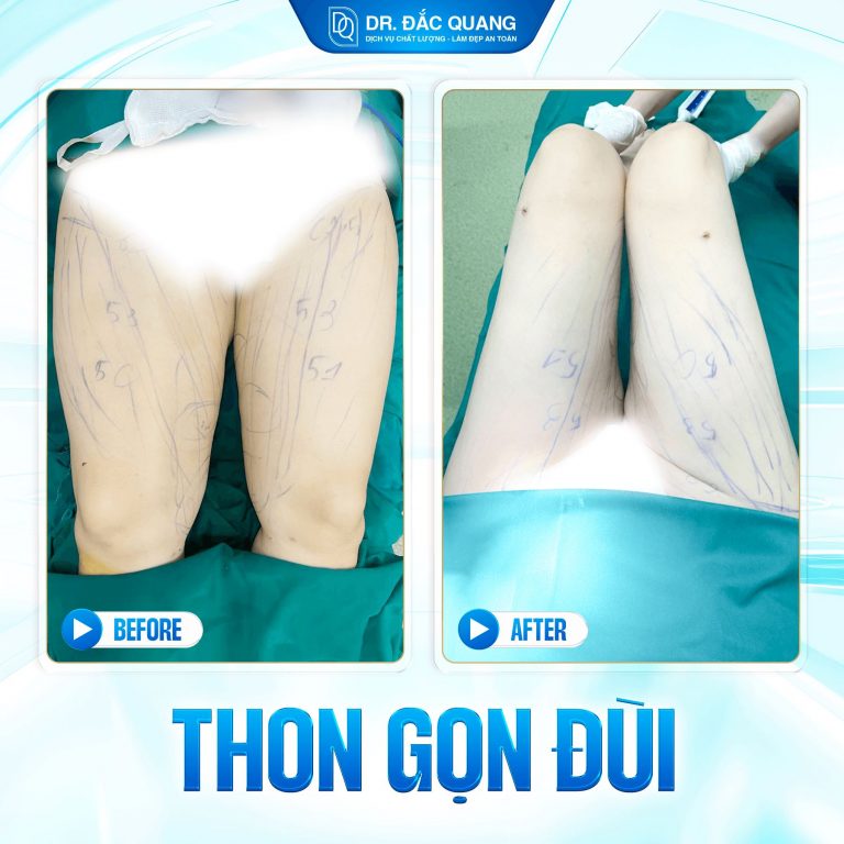 hút mỡ đùi, hút mỡ bắp chân