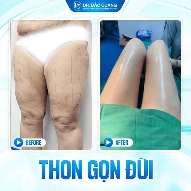 hút mỡ đùi, hút mỡ bắp chân